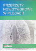 Przerzuty nowotworowe w płucach