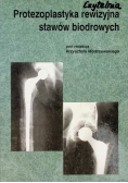 Protezoplastyka rewizyjna stawów biodrowych