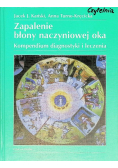 Zapalenie błony naczyniowej oka