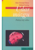 Udar mózgu
