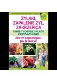 Żylaki zapalenie żył zakrzepica i inne choroby