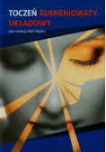 Toczeń rumieniowaty układowy