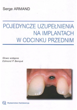 Pojedyncze uzupełnienia na implantach w odcinku przednim