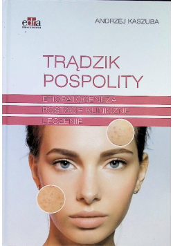 Trądzik pospolity