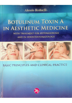 Botulinum Toxina a in Aesthetic Medicine with treatment for hyperhidrosis and in odontostomatology